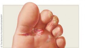 Atletsko stopalo - gljivična infekcija