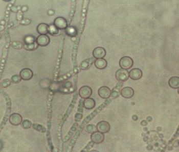 Gljivične infekcije - kandidijaza