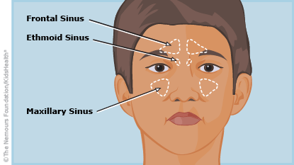 Sinuzitis